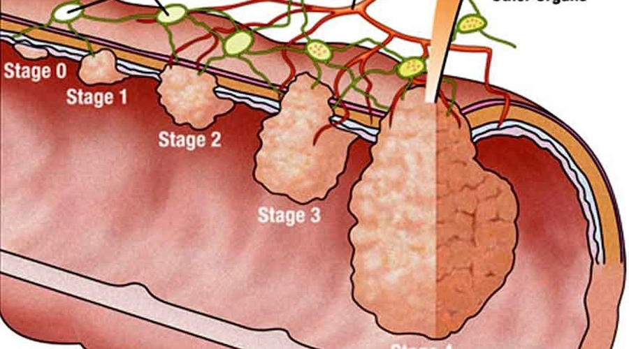 پیشگیری و تشخیص زودرس سرطان روده بزرگ